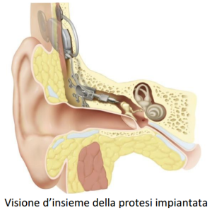 Dipo Srl - Carina Protesi